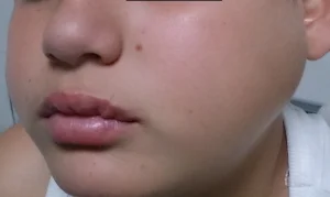 Parotiditis Parotitis Mumps
